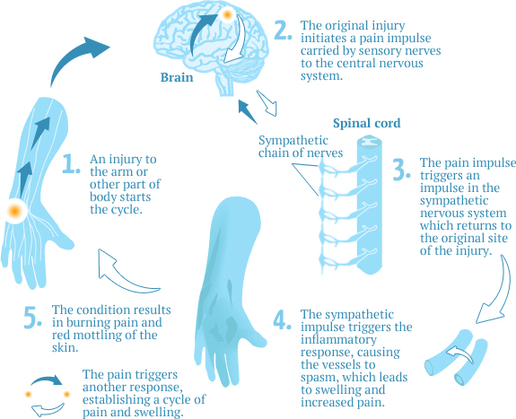 CRPS Diagram CRPS Diagram